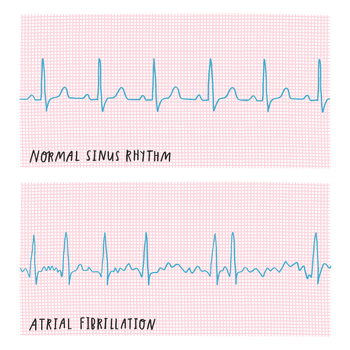 What is an AICD (Automatic Implantable Cardioverter Defibrillator)?